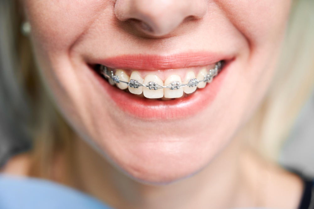 Braces & Aligners in Ahmedabad