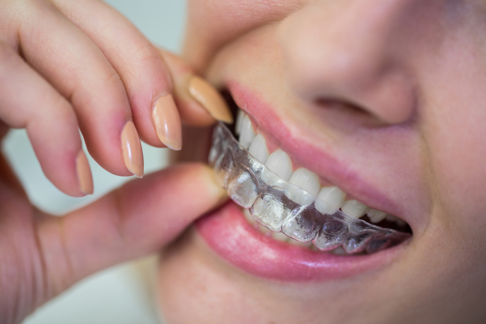 Braces & Aligners