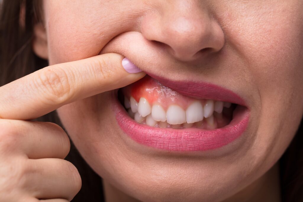 Gum Disease Treatments