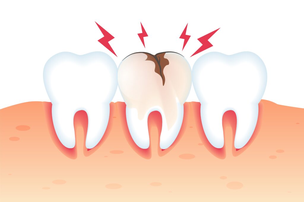 Prosthodontics Treatment in Ahmedabad