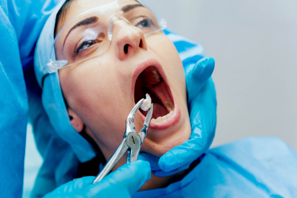 Wisdom Tooth Extraction in Ahmedabad